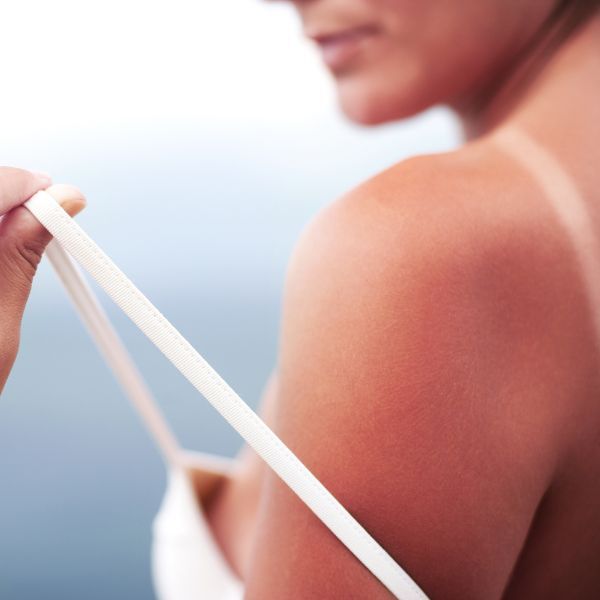 Sun Damage
When you spend long hours in the sun without any UV protection, your skin is left vulnerable to sun damage. Signs of sun damage include freckles, sun spots, and premature aging. Fortunately, within a single IPL skin treatment, we can reduce these signs by up to 70%.