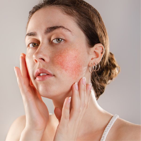 Rosacea If you frequently have a bright red face with subtle, acne-like bumps, you may have rosacea. This complexion concern can be frustrating because it makes it look like you’re always blushing. Within one to three IPL treatments, however, you can reduce your skin’s redness by up to 75%, making this problem a thing of the past.