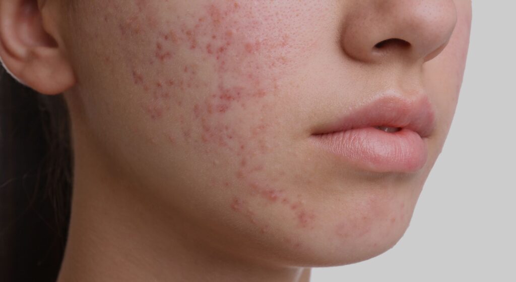 IPL Acne Scars