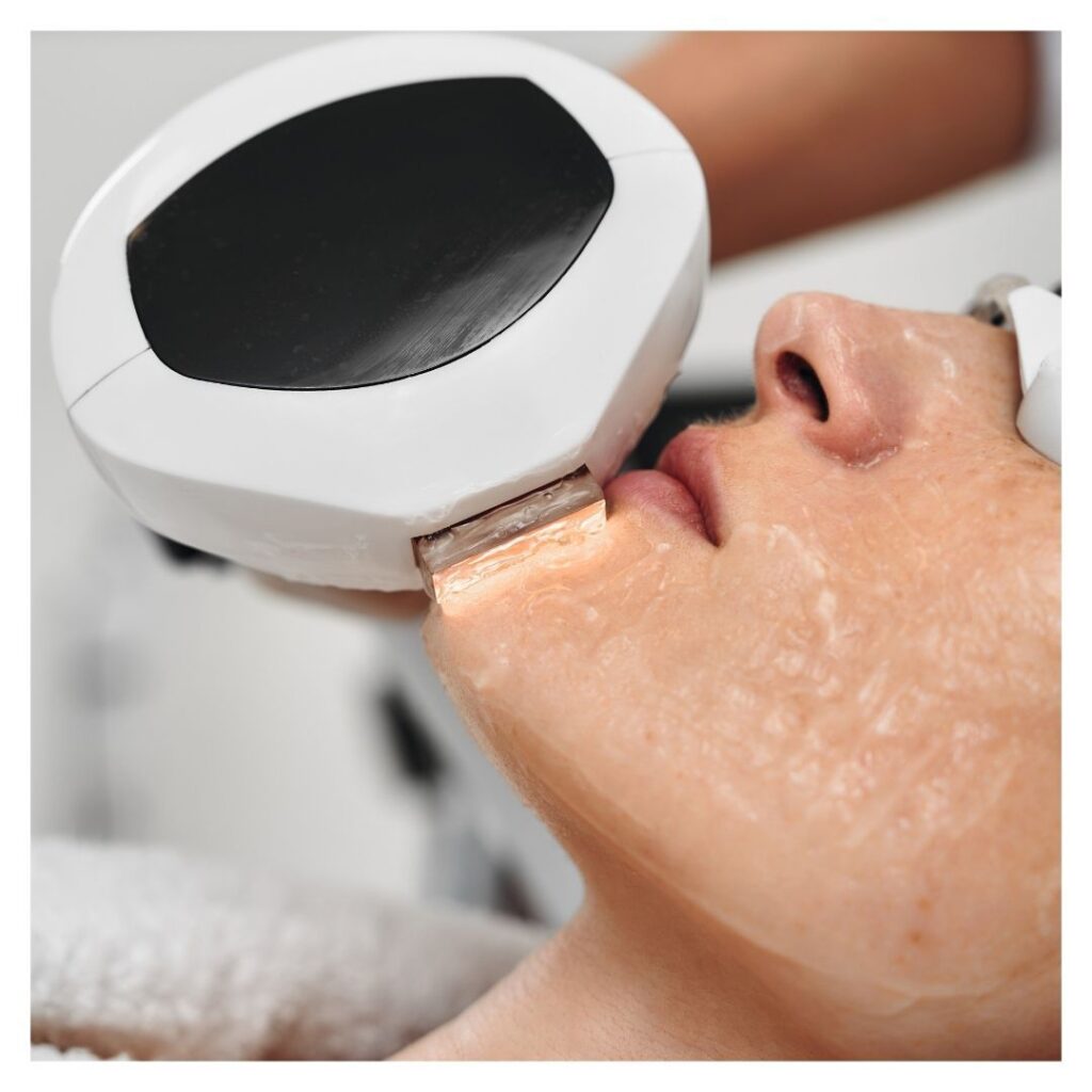 Understanding IPL Treatment Cycles