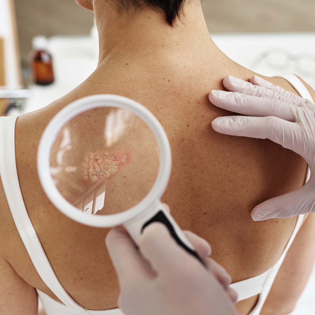 Dermatologist inspecting scaly patch on patient scapula Top 10 Reasons to Visit a Dermatologist for Your Skin Care Needs