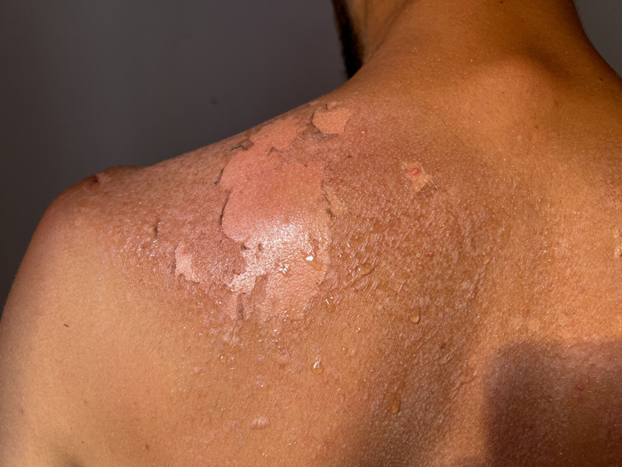 Peel back and shoulder skin from sunburn effect on young man body from sunbathing in summer