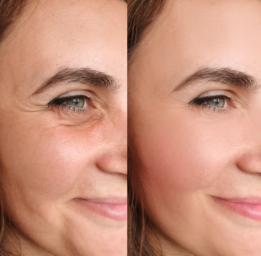 woman face wrinkles before and after treatment plan over time