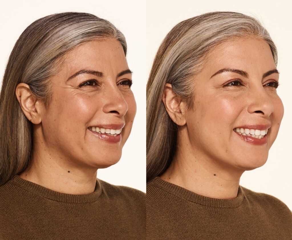 Botox Treatment for Crows Feet