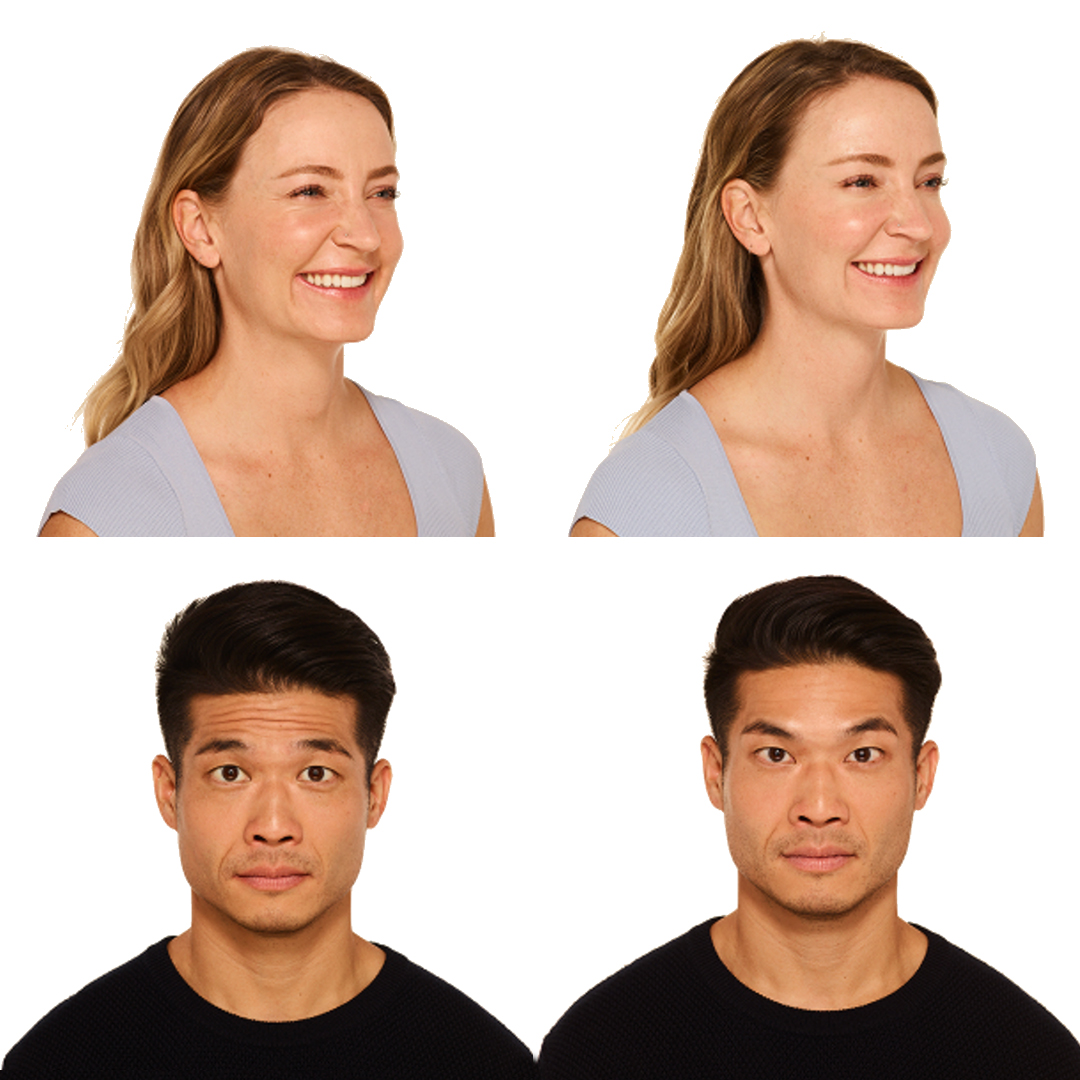 Botox Before After photos