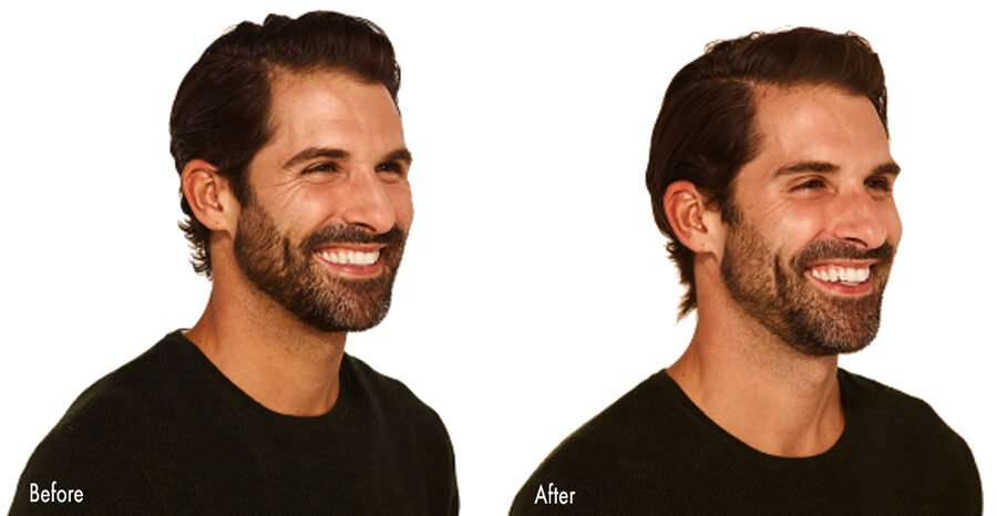 Crows Feet on Man before and after Botox