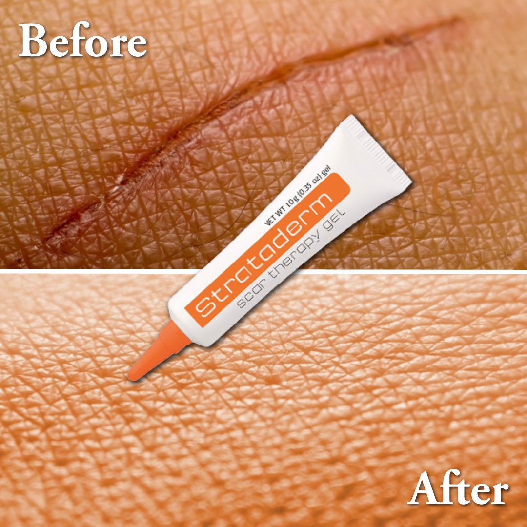 Strataderm heal your scars - before and after pics
