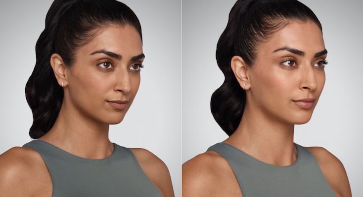 Woman showing photo of face before and after getting fillers treatment at K2 Derm