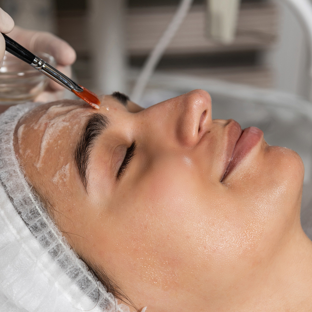 Jessner Peel at K2 Dermatology in Boulder, CO