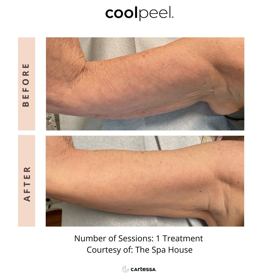 Cool Peel Arms