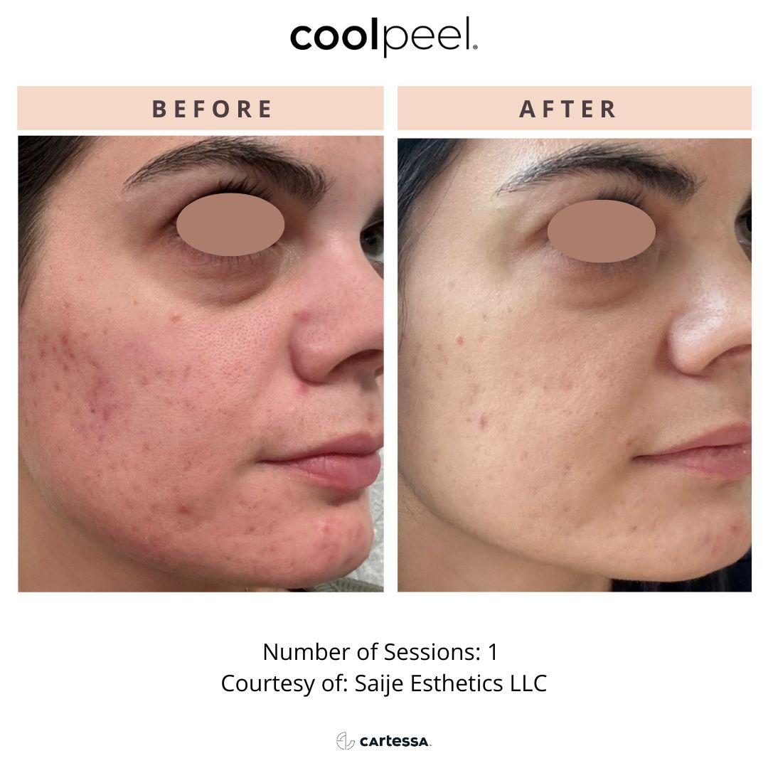 CoolPeelSaijeEsthetics1173437797129