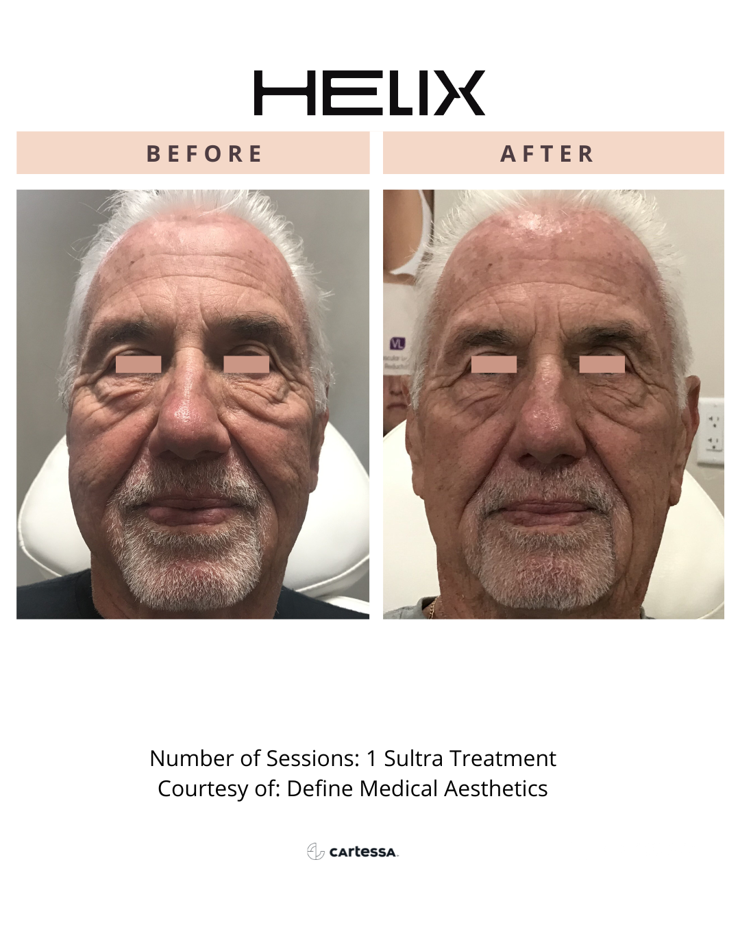 HELIXBA332176001779085