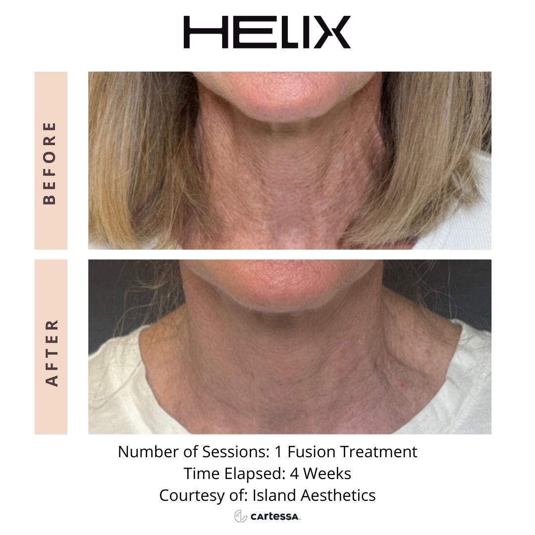 Helix9_Neck