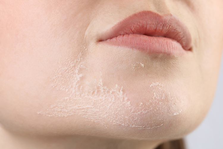 chemical peeling face